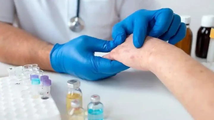 Lupus Bisa Cepat Terkendali atau Naik Turun – Ini Faktornya