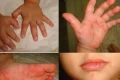 Lebih Menular dari Covid-19 – Dokter Sebut Flu Singapura Mudah Menyebar di Sekolah dan Daycare